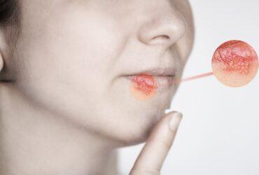 domowe sposoby na opryszczkę; opryszczka domowe sposoby; opryszczka na ustach domowe sposoby; jak pozbyć się opryszczki w jeden dzień domowe sposoby; zimno na ustach domowe sposoby; cebula na opryszczkę; czosnek na opryszczkę; co na opryszczke; opryszczka jak się pozbyć